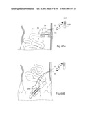 APPARATUS FOR CONTROLLING FLOW IN A BODILY ORGAN diagram and image