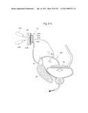 APPARATUS FOR CONTROLLING FLOW IN A BODILY ORGAN diagram and image