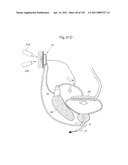 APPARATUS FOR CONTROLLING FLOW IN A BODILY ORGAN diagram and image