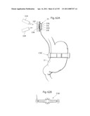 APPARATUS FOR CONTROLLING FLOW IN A BODILY ORGAN diagram and image