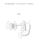 APPARATUS FOR CONTROLLING FLOW IN A BODILY ORGAN diagram and image