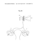 APPARATUS FOR CONTROLLING FLOW IN A BODILY ORGAN diagram and image