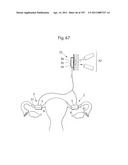 APPARATUS FOR CONTROLLING FLOW IN A BODILY ORGAN diagram and image