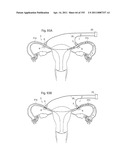 APPARATUS FOR CONTROLLING FLOW IN A BODILY ORGAN diagram and image