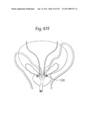 APPARATUS FOR CONTROLLING FLOW IN A BODILY ORGAN diagram and image