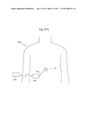 APPARATUS FOR CONTROLLING FLOW IN A BODILY ORGAN diagram and image