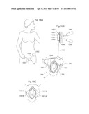 APPARATUS FOR CONTROLLING FLOW IN A BODILY ORGAN diagram and image