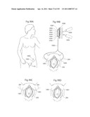 APPARATUS FOR CONTROLLING FLOW IN A BODILY ORGAN diagram and image