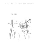 APPARATUS FOR CONTROLLING FLOW IN A BODILY ORGAN diagram and image