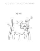 APPARATUS FOR CONTROLLING FLOW IN A BODILY ORGAN diagram and image