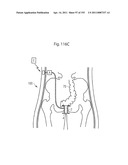 APPARATUS FOR CONTROLLING FLOW IN A BODILY ORGAN diagram and image