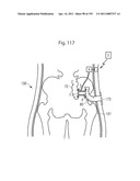 APPARATUS FOR CONTROLLING FLOW IN A BODILY ORGAN diagram and image