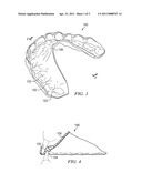 Custom-Molded Oral Appliance and Method of Forming diagram and image