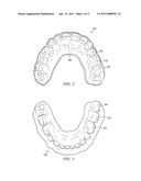 Custom-Molded Oral Appliance and Method of Forming diagram and image