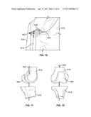 Patient-Specific Pre-Operative Planning diagram and image