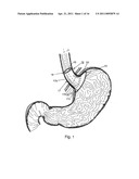 BARIATRIC DEVICE AND METHOD diagram and image