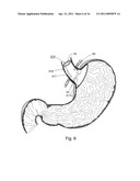 BARIATRIC DEVICE AND METHOD diagram and image