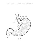 BARIATRIC DEVICE AND METHOD diagram and image