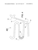 HYBRID STENT WITH HELICAL CONNECTORS diagram and image
