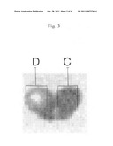 Diagnosis of Prostate Cancer diagram and image