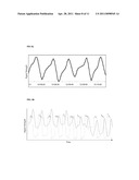 METHOD FOR USING PHOTOPLETHYSMOGRAPHY TO OPTIMIZE FLUID REMOVAL DURING RENAL REPLACEMENT THERAPY BY HEMODIALYSIS OR HEMOFILTRATION diagram and image