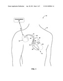 DEFLECTABLE SUBSELECTING CATHETER diagram and image