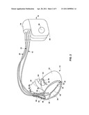 DEFLECTABLE SUBSELECTING CATHETER diagram and image