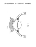 GLAUCOMA TREATMENT DEVICE diagram and image