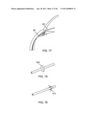 GLAUCOMA TREATMENT DEVICE diagram and image