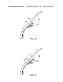 GLAUCOMA TREATMENT DEVICE diagram and image