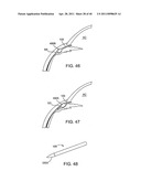 GLAUCOMA TREATMENT DEVICE diagram and image