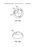 GLAUCOMA TREATMENT DEVICE diagram and image