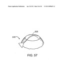 GLAUCOMA TREATMENT DEVICE diagram and image