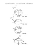 GLAUCOMA TREATMENT DEVICE diagram and image