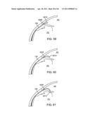 GLAUCOMA TREATMENT DEVICE diagram and image