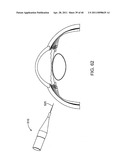 GLAUCOMA TREATMENT DEVICE diagram and image