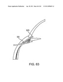 GLAUCOMA TREATMENT DEVICE diagram and image