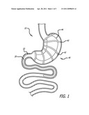 Methods And Devices For Anchoring A Gastroenterologic Sleeve diagram and image