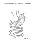 Methods And Devices For Anchoring A Gastroenterologic Sleeve diagram and image