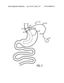 Methods And Devices For Anchoring A Gastroenterologic Sleeve diagram and image