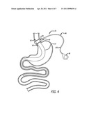 Methods And Devices For Anchoring A Gastroenterologic Sleeve diagram and image