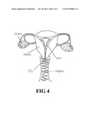 MEDICAL DEVICES FOR TREATING UROLOGICAL AND UTERINE CONDITIONS diagram and image