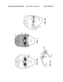 DEVICE DELIVERING MEDICINES BY TRANSPALPEBRAL ELECTROPHORESIS diagram and image