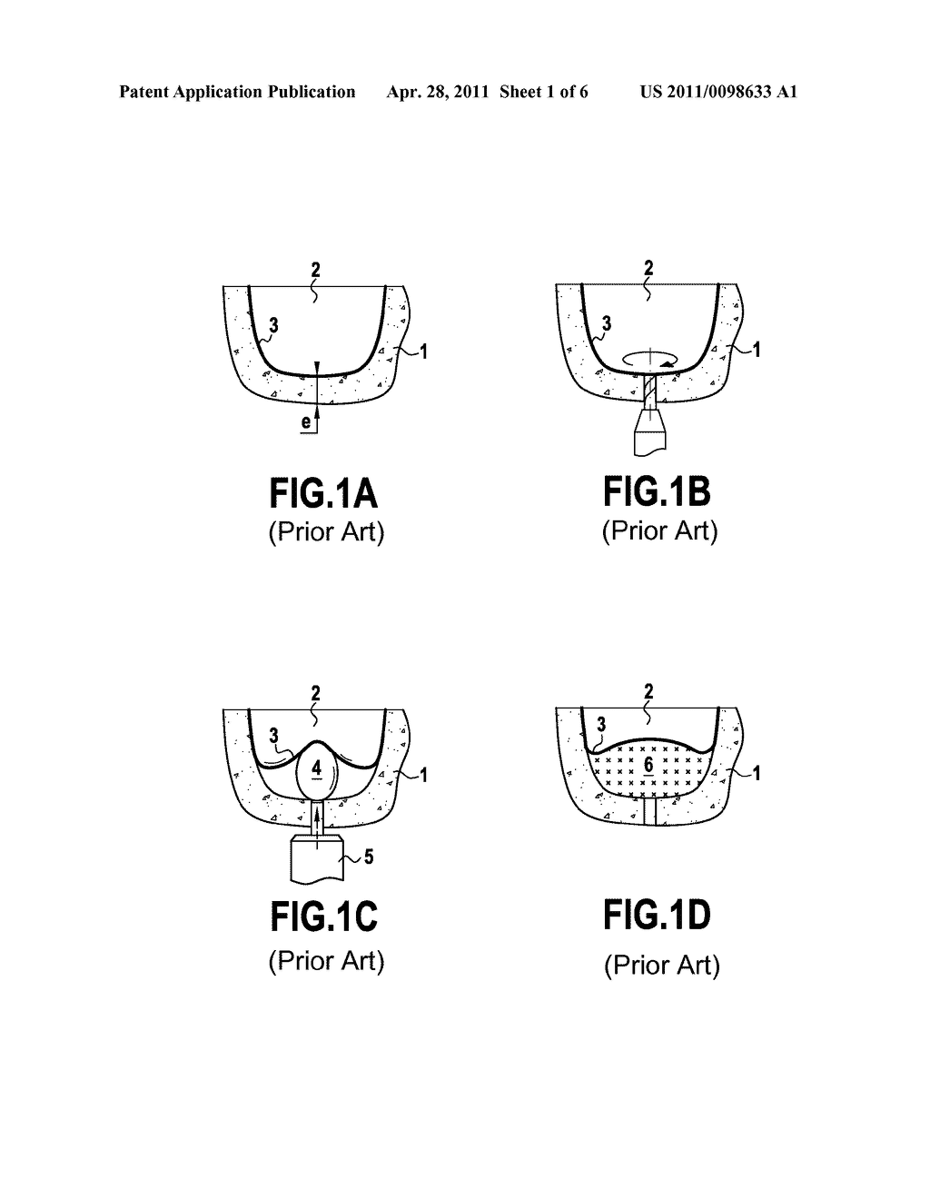 ULTRASONIC TIP FOR SINUS MEMBRANE ELEVATION - diagram, schematic, and image 02