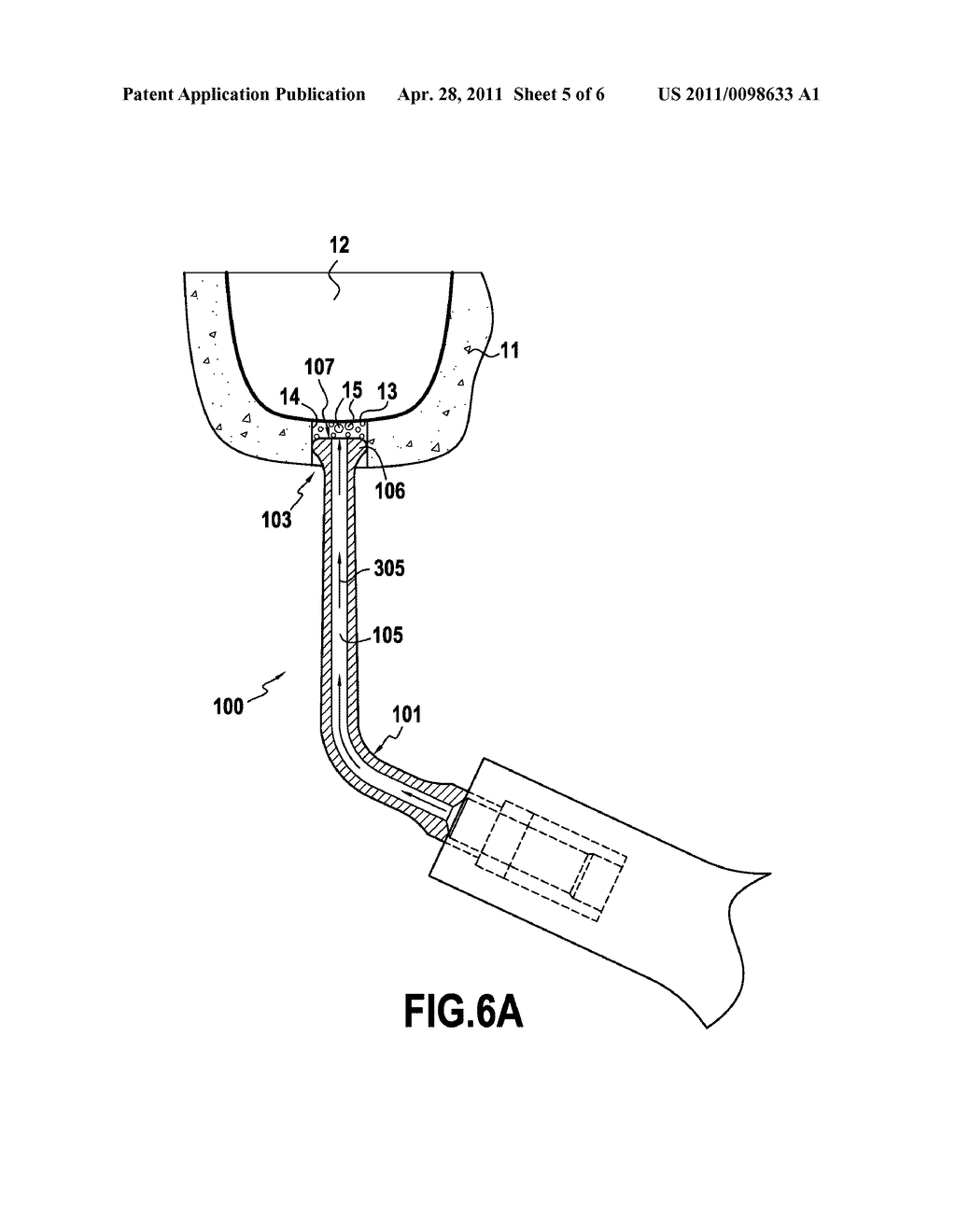 ULTRASONIC TIP FOR SINUS MEMBRANE ELEVATION - diagram, schematic, and image 06