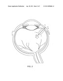 Reservoir Device for Intraocular Drug Delivery diagram and image