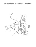 Cam Action Detachment for Tracheostomy Tube diagram and image