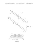 METHODS FOR REMOVING KIDNEY STONES FROM THE URETER diagram and image