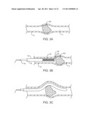 METHODS FOR REMOVING KIDNEY STONES FROM THE URETER diagram and image