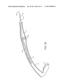 METHODS FOR REMOVING KIDNEY STONES FROM THE URETER diagram and image